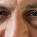 Augenlider dicke geschwollene Tränensäcke: Tipps