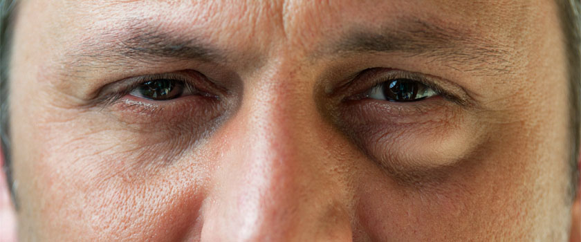 Geschwollene Augen: Ursachen, Symptome, Behandlung