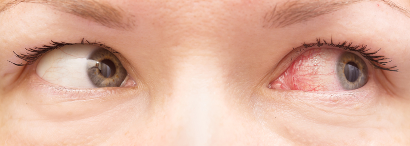 Rote Augen – Ursachen u. Behandlung I CARE Vision Blog