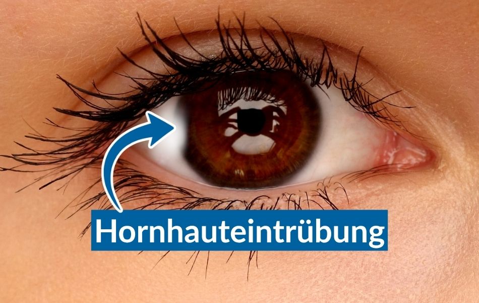 hornhauteintrübung (1)