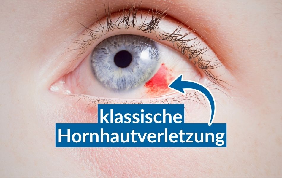 hornhautverletzung (1)