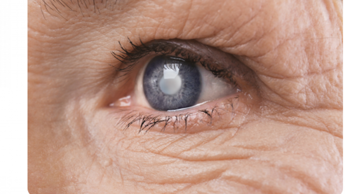 Grauer Star OP  Ablauf, Kosten, Erfahrungen | CARE Vision