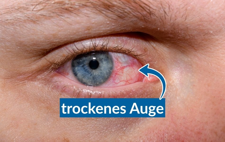 trockenes auge (1)